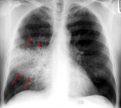 Chest Radiology